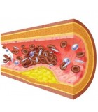Colesterol, Triglicéridos y Arterioesclerosis